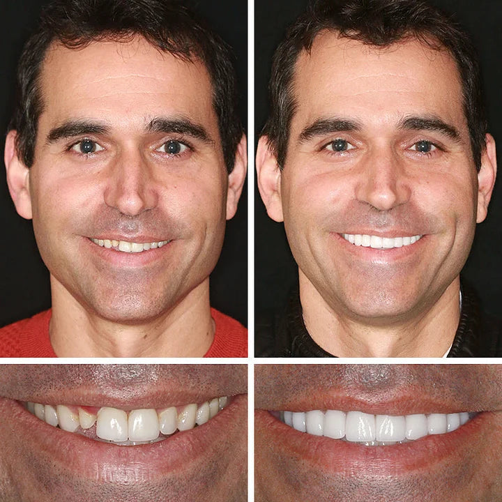 🏆Ends Today: 70% OFF! 🏆2026 Bestselling Product🦷 Fit for a Fresh Smile, Say Goodbye to Wearing Discomfort!🌎