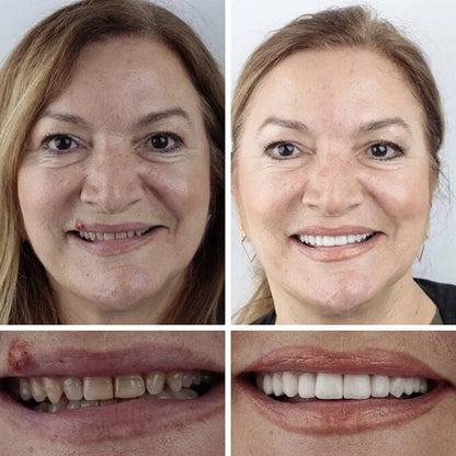 🏆Ends Today: 70% OFF! 🏆2026 Bestselling Product🦷 Fit for a Fresh Smile, Say Goodbye to Wearing Discomfort!