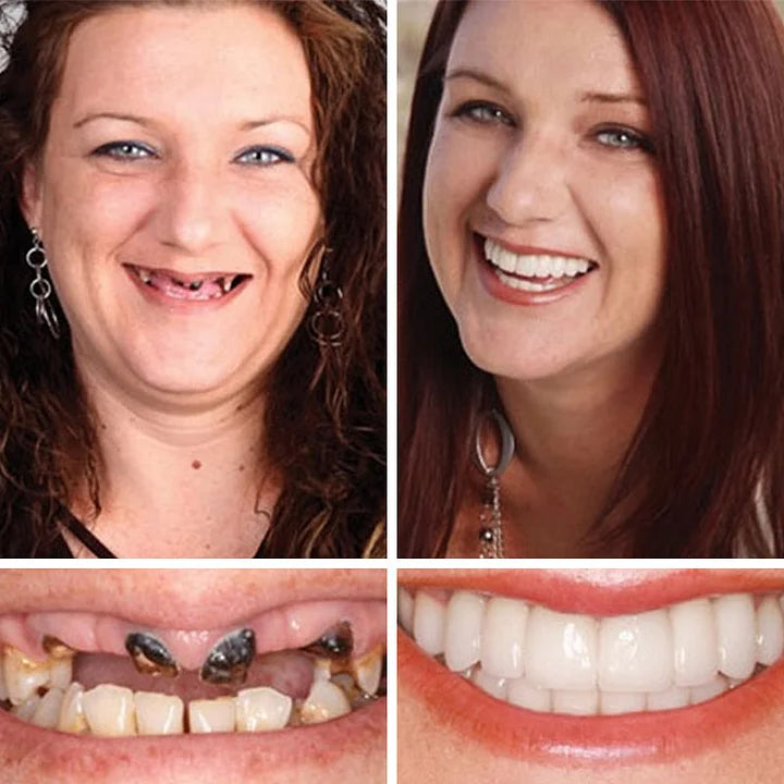 🏆Ends Today: 70% OFF! 🏆2026 Bestselling Product🦷 Fit for a Fresh Smile, Say Goodbye to Wearing Discomfort!
