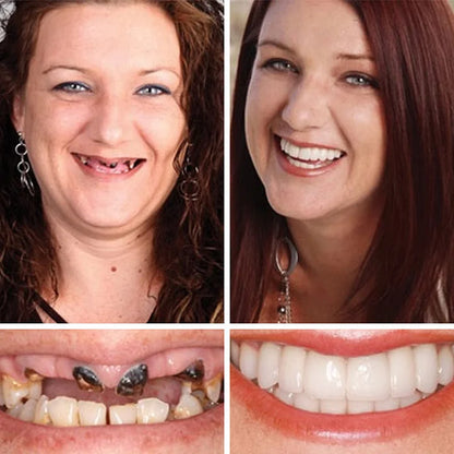 🏆Ends Today: 70% OFF! 🏆2026 Bestselling Product🦷 Fit for a Fresh Smile, Say Goodbye to Wearing Discomfort!
