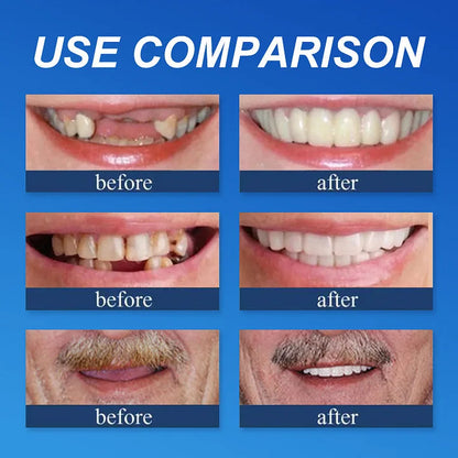 🏆Ends Today: 70% OFF! 🏆2026 Bestselling Product🦷 Fit for a Fresh Smile, Say Goodbye to Wearing Discomfort!